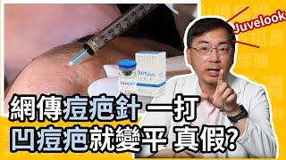 凹痘疤治療新突破，網傳超夯痘疤針，真的有效嗎？如何用 Juvelook 喬雅露改善凹痘疤？