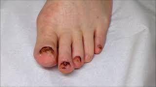 What Fungal Nails Look Like After Surgical  Removal