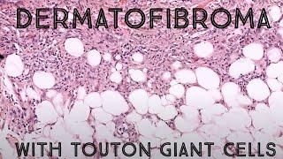 Dermatofibroma with hemosiderin laden Touton giant cells (pathology dermpath dermatology)