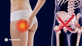 Pain in the butt - It's NOT Piriformis Syndrome