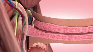 Peyronie's Disease treatment Animation, Steinberg Urology Montreal