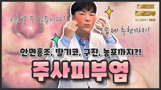 주사피부염, 안면홍조, 장미증 - 얼굴이 붉어지고 염증이 발생하는 질환 치료는 이렇게 / 연세에이앤비 피부과 이해진 원장