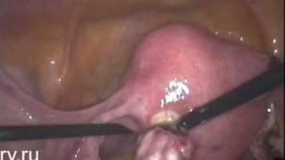 Removal of the small subserous myoma