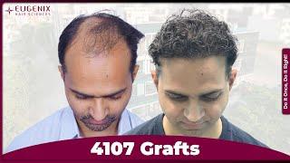 The Incredible Hair Transplant Journey with Eugenix | Watch Natural Transformation Journey