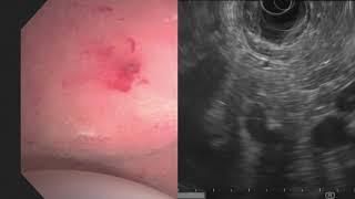 Importance of water insufflation in the EUS