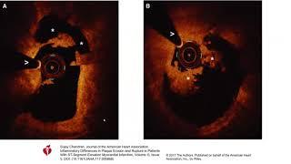 Types of plaque disruption by OCT and value of OCT in MINOCA- Elias Hanna, Univ of Iowa