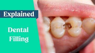 Dental Fillings Explained