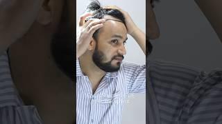 "Best Hair Transplant in India: Sapphire FUE Transformations at Cara Clinic, Mumbai"