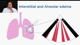 How to do COVID Lung Ultrasound (THAI)