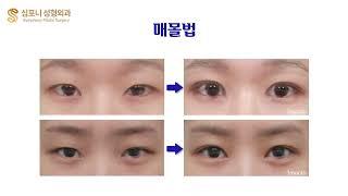 Double Eyelid Surgery : Before & After Symphony Plastic Surgery Korea - Non-incision/Incision