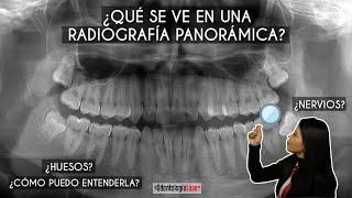 ¿Qué se ve en una radiografía panorámica? ¿Cómo puedo entenderla?  - Odontología Láser.