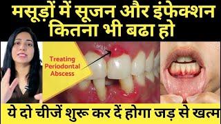 मसूड़ों की सूजन और इंफैक्शन को करे जड़ से खत्म | Eliminate Gum Swelling And Infection From Its Roots