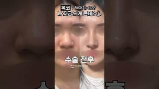 콧볼축소하고 왕코 탈출한 후기 전후 비교 #shorts