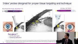 Iridex Academy: A Primer on MicroPulse Transscleral Laser Therapy for Glaucoma - Brian Francis, MD