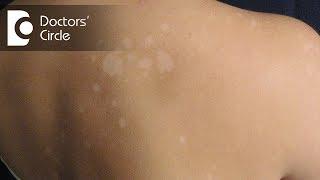 Managing round irregular skin patches not responding to topical creams-Dr. Rasya Dixit