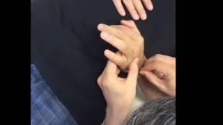 Wrist pain,  TFCC - Heated acupuncture and Kinetic acupuncture