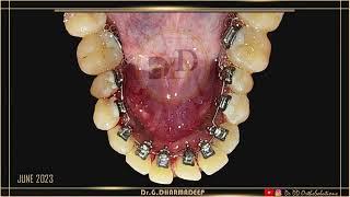 Management of Constricted Mandibular Arch by Expansion with Selfy Lingual System.