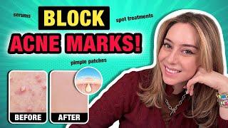 How to Prevent & Treat Acne Scars for Brighter Skin! | Dr. Shereene Idriss