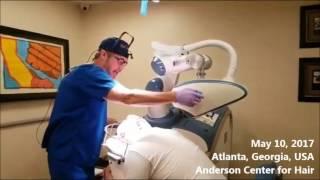 LIVE ARTAS Robotic Hair Transplant Surgery - see follicles removed by a robot