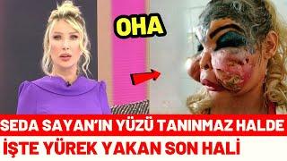 Estetik Yüzünden Tanınmaz Hale Gelen Ünlüler | Seda Sayan'ın Son Hali