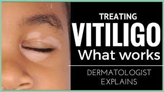 Vitiligo treatments- what works!