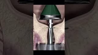 شوف كفاش إعادة غشاء البكارة