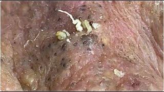 Massive Blackheads removal #2