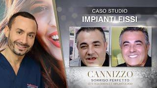 Implantologia Fissa Prima e Dopo - Studio Cannizzo