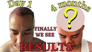 4 Months Results POST FUE Hair Transplant done in Turkey/ Finally we are seeing the hair growing