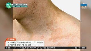 ※여름철 주의해야 할 피부질환!※ 소중한 내 피부 절대지켜!! | 행복한 아침 890 회