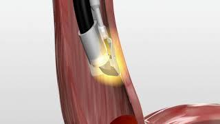 BARRX 90 - Endoskopska radiofrekventna ablacija Barrett-ovog jednjaka