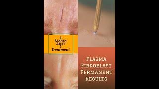 Plasma Fibroblast Permanent Results at  Siren Design