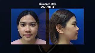 The Journey of OGS to correct facial asymmetry