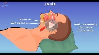 L’apnée du sommeil, qu’est-ce que c’est ?