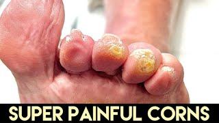 SUPER RELAXING DEBRIDEMENT OF MULTIPLE TOE CORNS ** BRING THE PILLOW