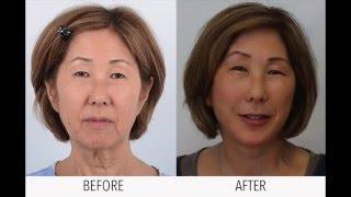 Face Lift Surgery