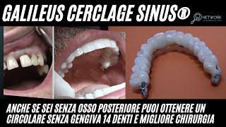 Implantologia senza gengiva chirurgica Galileus Cerclage Sinus®