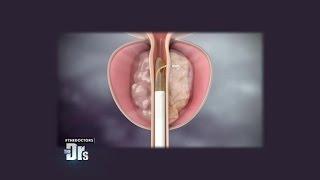 Dr. Ordon’s Prostate Procedure