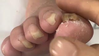 How to Fix Curved Toenails (Step-by-Step Guide)