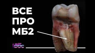 ЭНДОДОНТИЯ МБ2 КАНАЛ как найти как обработать