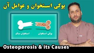 پوکی استخوان چیست | دلیل و علت پوکی استخوان چیست | اورتوپیدی چیست؟ | Osteoporosis & causes