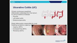 IBD 101: An Overview of Inflammatory Bowel Disease