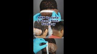 AKN Update: 2 Years Post Surgery - Dr. U