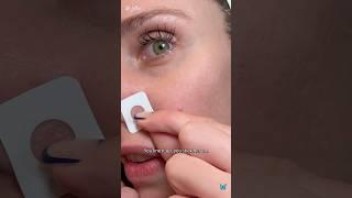 How An Esthetician Gets Rid Of A Pimple In 1 Day!! Zitsticka Killa Patch #zitsticka #acne #skincare