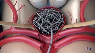 Surgical Treatment Options for Brain Aneurysms | Ethan Winkler, MD, PhD