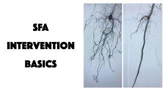 SFA Intervention Basics