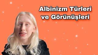 Albinism Types and Appearances