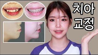 ️성형효과?! 덧니,돌출입 치아교정 후기 +가격,통증,전후사진 [#Review]- [쩡유]