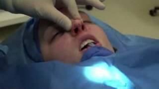 Dr. John Bitner Rhinoplasty (Nose Job) - Dr. Bitner