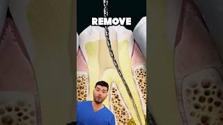 Root Canal Explained !?